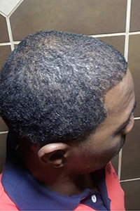 Unsatisfied With Another Doctor's Work? Corrective Hair Transplants Are Dr. Bolton's Specialty African American Patients Before And Afters Crown Difficult Cases Hairline Suture Line/Scar 