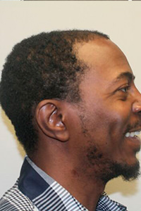 Unsatisfied With Another Doctor's Work? Corrective Hair Transplants Are Dr. Bolton's Specialty African American Patients Before And Afters Crown Difficult Cases Hairline Suture Line/Scar 