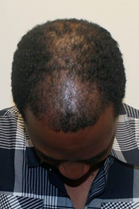 Unsatisfied With Another Doctor's Work? Corrective Hair Transplants Are Dr. Bolton's Specialty African American Patients Before And Afters Crown Difficult Cases Hairline Suture Line/Scar 