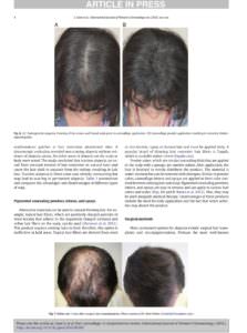 Dr. Bolton's Work Published In Journal Of Women's Dermatology Hair Transplant Industry Exposed 