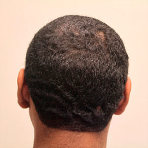 What Does The Scar Look Like After A MaxHarvest™ Hair Transplant? African American Patients Hair Transplant Industry Exposed Healing/Growth Process Suture Line/Scar Testimonials 