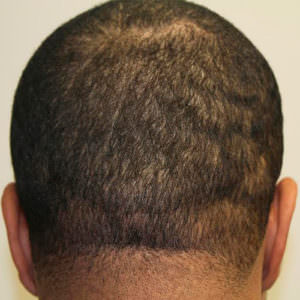 What Does The Scar Look Like After A MaxHarvest™ Hair Transplant? African American Patients Hair Transplant Industry Exposed Healing/Growth Process Suture Line/Scar Testimonials 