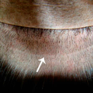 What Does The Scar Look Like After A MaxHarvest™ Hair Transplant? African American Patients Hair Transplant Industry Exposed Healing/Growth Process Suture Line/Scar Testimonials 