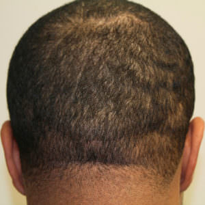 Can You Find This Scar After Our FUT Hair Transplant? African American Patients Before And Afters Hairline Healing/Growth Process Suture Line/Scar