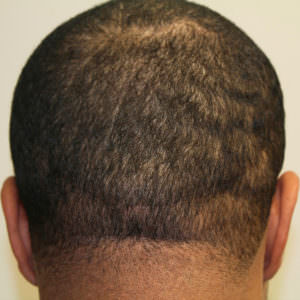 Can You Find This Scar After Our FUT Hair Transplant? African American Patients Before And Afters Hairline Healing/Growth Process Suture Line/Scar 