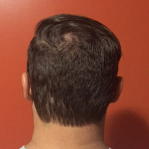 Forced To Shave Your Head Due To Hair Loss? Before And Afters Hairline 