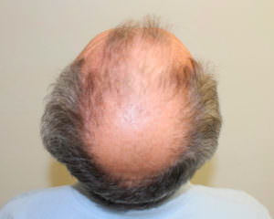 Want To Cover Your Head With Hair? Before And Afters Difficult Cases Healing/Growth Process MaxHarvest Plus™ Procedures