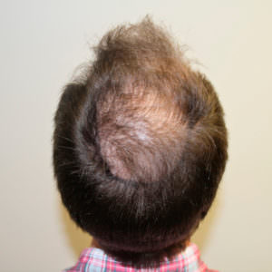 Dr. Bolton - Great Hair Transplants Updates European Patient Flies In To Have Hair Transplant Before And Afters Crown Hairline Healing/Growth Process MaxHarvest Plus™ Procedures