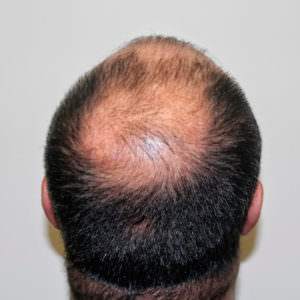 Cover A Large Area Of Hair Loss With 1 Hair Transplant Before And Afters Crown Difficult Cases Hairline Healing/Growth Process 