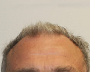 Want To Cover Your Head With Hair? Before And Afters Difficult Cases Healing/Growth Process MaxHarvest Plus™ Procedures 