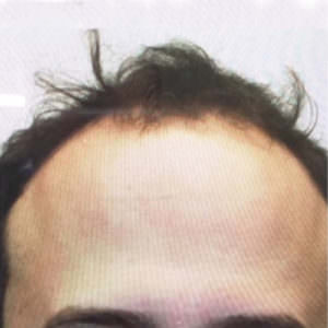 Patient Gets His Old Hairline Back After Hair Transplant Before And Afters Hairline 