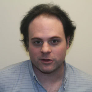 Tony's Continued Progress - Update 5 1/2 Months After Second Procedure! Before And Afters Hairline Healing/Growth Process 