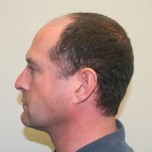 Hair Transplant Before And After Consistency Before And Afters Hairline