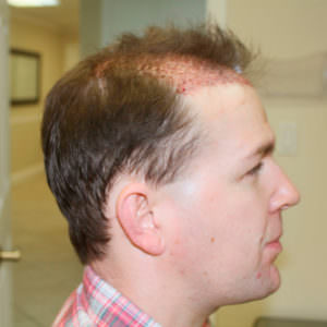 European Patient Flies In To Have Hair Transplant Before And Afters Crown Hairline Healing/Growth Process MaxHarvest Plus™ Procedures 