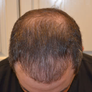 Get Your Hair Back With New Advancements In Hair Restoration Before And Afters Difficult Cases Hairline Healing/Growth Process MaxHarvest Plus™ Procedures 