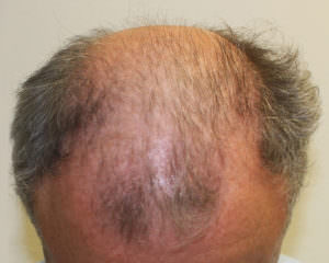 Want To Cover Your Head With Hair? Before And Afters Difficult Cases Healing/Growth Process MaxHarvest Plus™ Procedures 