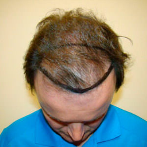 Regrow Your Hairline With A MaxHarvest™ Hair Transplant Before And Afters Hairline