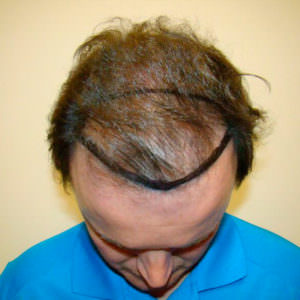 Regrow Your Hairline With A MaxHarvest™ Hair Transplant Before And Afters Hairline 