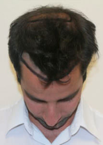 Do You Want A Lower And Thicker Hairline? Before And Afters Hairline 
