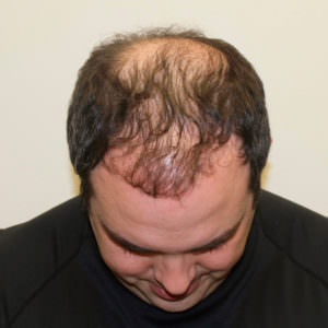 Get Your Hair Back With New Advancements In Hair Restoration Before And Afters Difficult Cases Hairline Healing/Growth Process MaxHarvest Plus™ Procedures