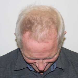 Hair Transplants Can Change Your Life, Regardless Of Age Before And Afters Hairline 