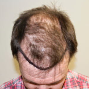 European Patient Flies In To Have Hair Transplant Before And Afters Crown Hairline Healing/Growth Process MaxHarvest Plus™ Procedures 