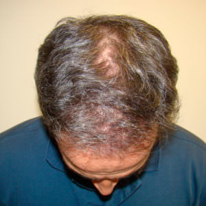 The Basic Healing Process Of A Hair Transplant Before And Afters Healing/Growth Process