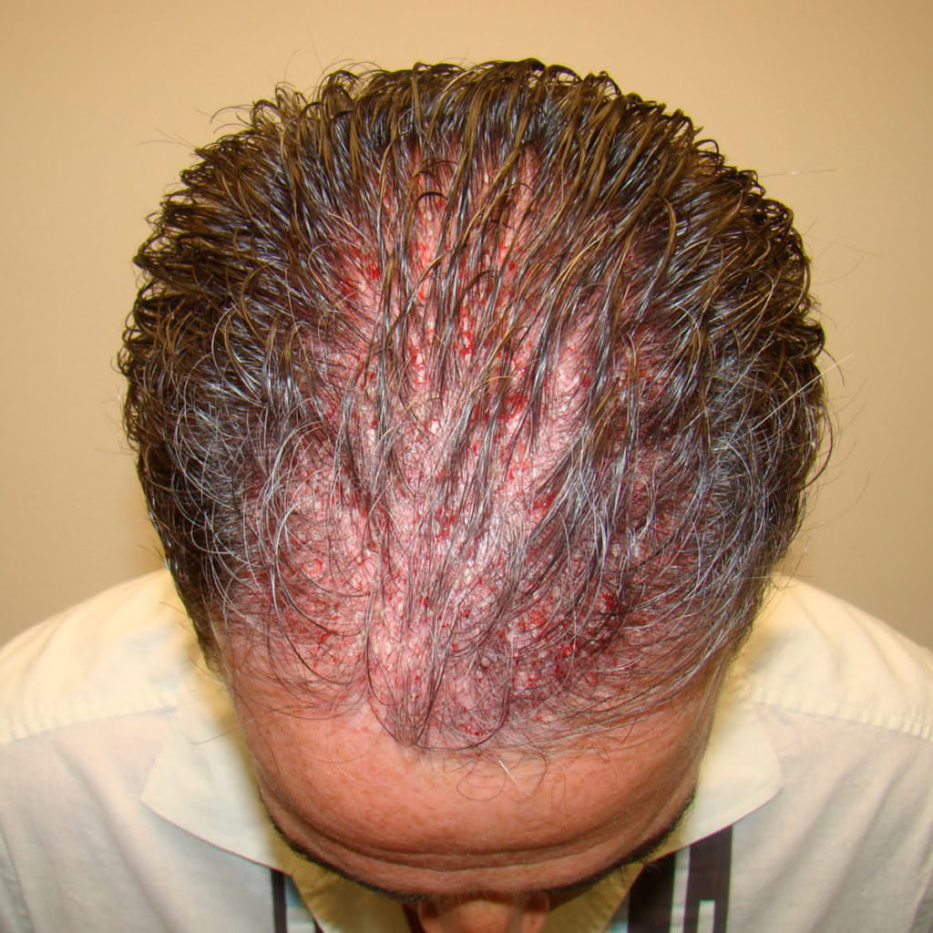 The Basic Healing Process Of A Hair Transplant Dr. Brett Bolton's