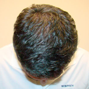 The Basic Healing Process Of A Hair Transplant Before And Afters Healing/Growth Process 