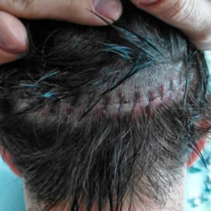 European Patient Flies In To Have Hair Transplant Before And Afters Crown Hairline Healing/Growth Process MaxHarvest Plus™ Procedures 