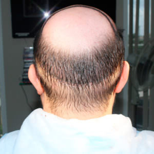 The Largest Hair Transplant Case In History Before And Afters Crown Difficult Cases Hair Transplant Industry Exposed Hairline Healing/Growth Process MaxHarvest Plus™ Procedures 