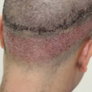 Which Type Of Hair Transplant Procedure Will You Opt For? Difficult Cases FUE Corrections Hair Transplant Industry Exposed 