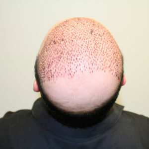 The Largest Hair Transplant Case In History Before And Afters Crown Difficult Cases Hair Transplant Industry Exposed Hairline Healing/Growth Process MaxHarvest Plus™ Procedures 
