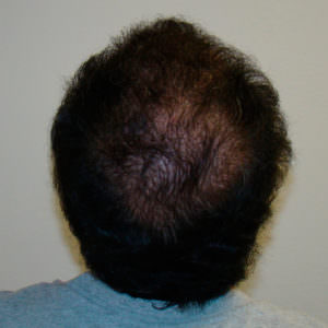 6 Month Results After Double Hair Transplant Correctional Procedure Before And Afters 