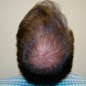 Large Balding Area? 1 MaxHarvest™ Hair Transplant Before And After Comparison Before And Afters Crown Difficult Cases Hairline 