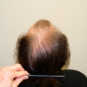 Dramatic 1 Procedure Hair Transplant Results Before And Afters Difficult Cases Hairline 