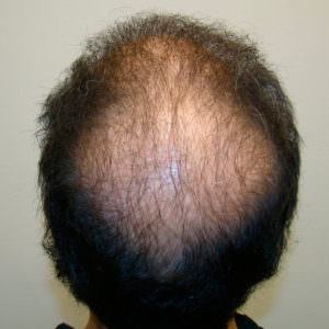 6 Month Results After Double Hair Transplant Correctional Procedure Before And Afters 