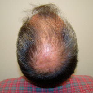 Large Balding Area? 1 MaxHarvest™ Hair Transplant Before And After Comparison Before And Afters Crown Difficult Cases Hairline 