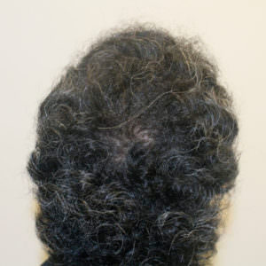 Great Hair Transplant Results Can Take Longer Than 12 Months Before And Afters Crown Healing/Growth Process Testimonials