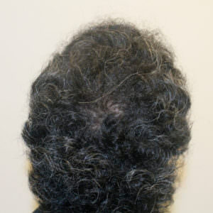 Great Hair Transplant Results Can Take Longer Than 12 Months Before And Afters Crown Healing/Growth Process Testimonials 