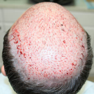 This Is The Most Effective Way To Restore Your Hair Before And Afters Crown Difficult Cases Hair Transplant Industry Exposed Hairline Healing/Growth Process MaxHarvest Plus™ Procedures