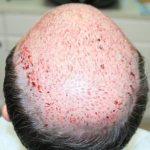 This Is The Most Effective Way To Restore Your Hair Before And Afters Crown Difficult Cases Hair Transplant Industry Exposed Hairline Healing/Growth Process MaxHarvest Plus™ Procedures 