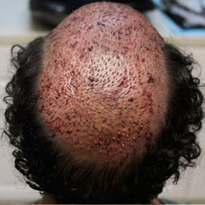 Which Type Of Hair Transplant Procedure Will You Opt For? Difficult Cases FUE Corrections Hair Transplant Industry Exposed 