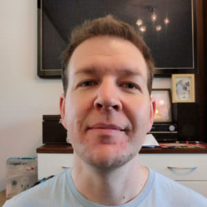Dr. Bolton - Great Hair Transplants Updates European Patient Flies In To Have Hair Transplant Before And Afters Crown Hairline Healing/Growth Process MaxHarvest Plus™ Procedures