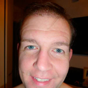 Dr. Bolton - Great Hair Transplants Updates European Patient Flies In To Have Hair Transplant Before And Afters Crown Hairline Healing/Growth Process MaxHarvest Plus™ Procedures