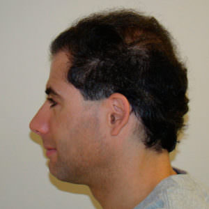 6 Month Results After Double Hair Transplant Correctional Procedure Before And Afters 