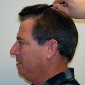 Dr. Bolton - Great Hair Transplants Updates Large Balding Area? 1 MaxHarvest™ Hair Transplant Before And After Comparison Before And Afters Crown Difficult Cases Hairline