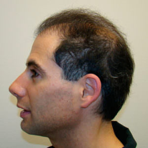 6 Month Results After Double Hair Transplant Correctional Procedure Before And Afters 