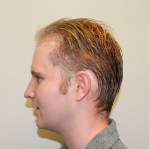 Young Man's Hairline Wish Granted After Meeting Dr. Bolton Before And Afters Hairline Healing/Growth Process