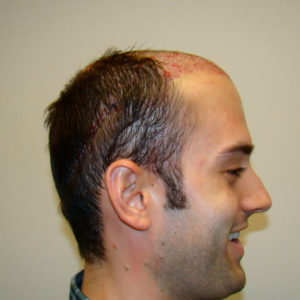 Ryan's Full Hair Transplant Journal Healing/Growth Process Testimonials 